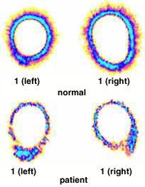 Kirlian effect